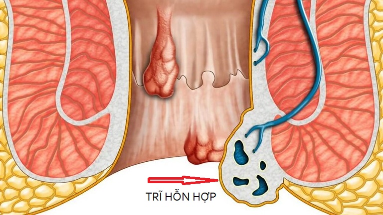 hình ảnh trĩ hỗn hợp