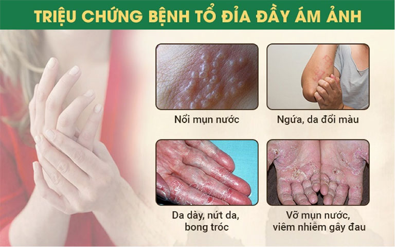 Triệu chứng bệnh tổ đỉa