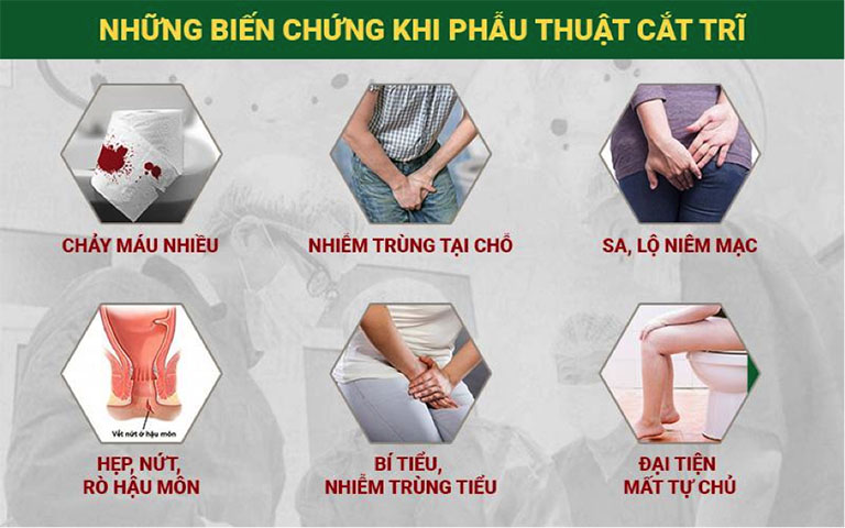 Phẫu thuật cắt trĩ 