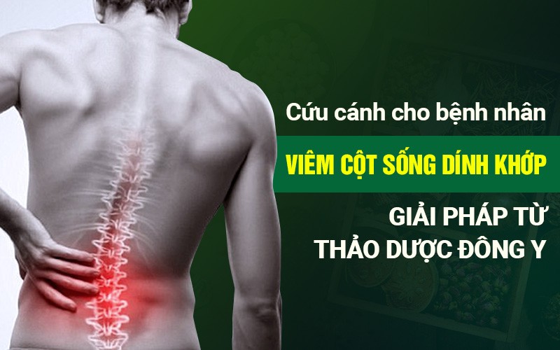 Giải pháp từ thảo dược Đông y - Cứu cánh cho bệnh nhân viêm cột sống dính khớp