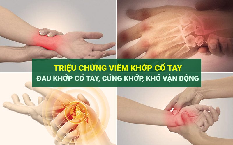 Triệu chứng viêm khớp cổ tay