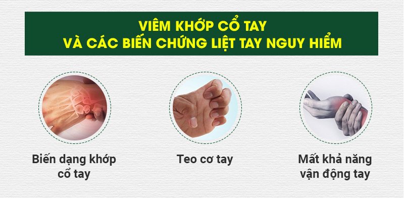 Viêm khớp cổ tay và biến chứng liệt tay