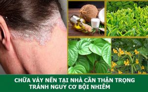 Cách chữa vảy nến da đầu tại nhà giảm ngứa