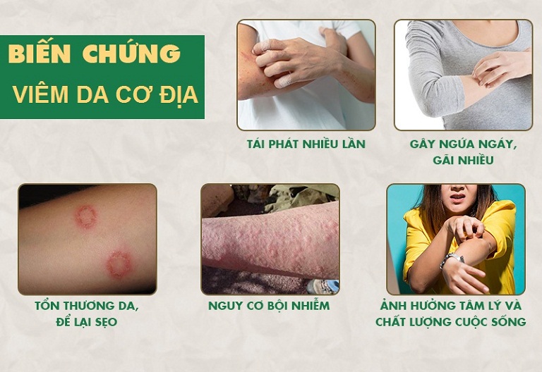 Biến chứng nguy hiểm của bệnh viêm da cơ địa