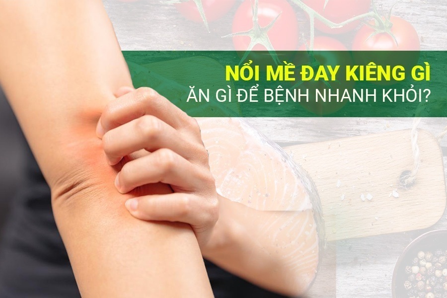 Nổi mề đay kiêng gì, ăn gì?