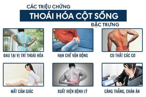 Biểu hiện thoái hóa cột sống lưng