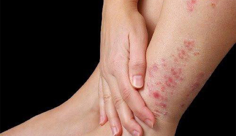 Giữ ẩm cho chân để hạn chế tình trạng viêm da cơ địa