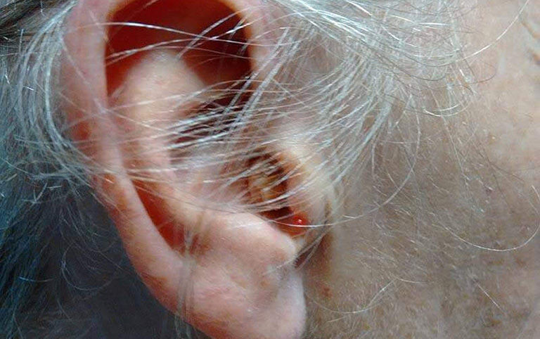 Viêm tai ngoài là gì?