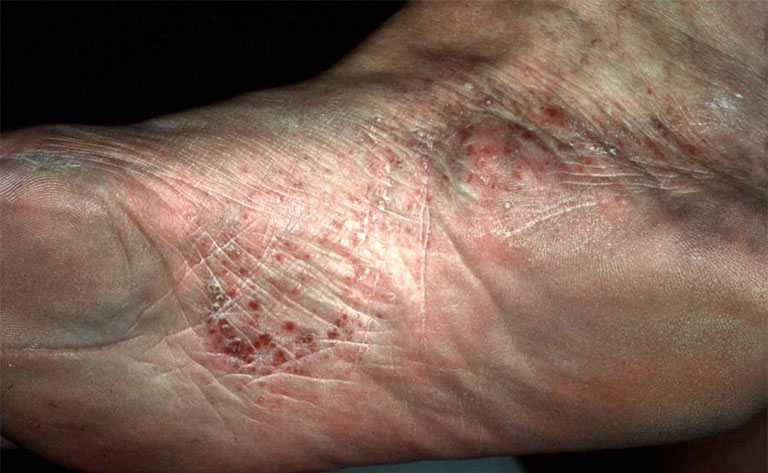 dấu hiệu bệnh tổ đỉa ở chân