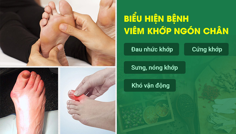 Biểu hiện của bệnh viêm khớp ngón chân