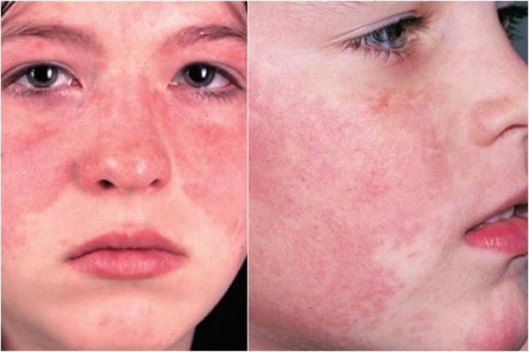 Lupus ban đỏ khiến vùng da mặt xuất hiện hồng ban có dạng hình cánh bướm đặc trưng.