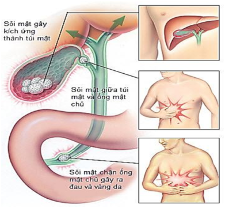 Tắc ống mật do giun