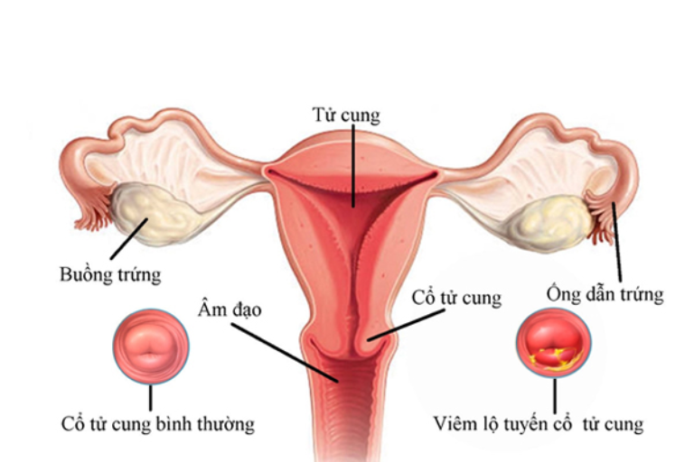 Bệnh viêm lộ tuyến cổ tử cung