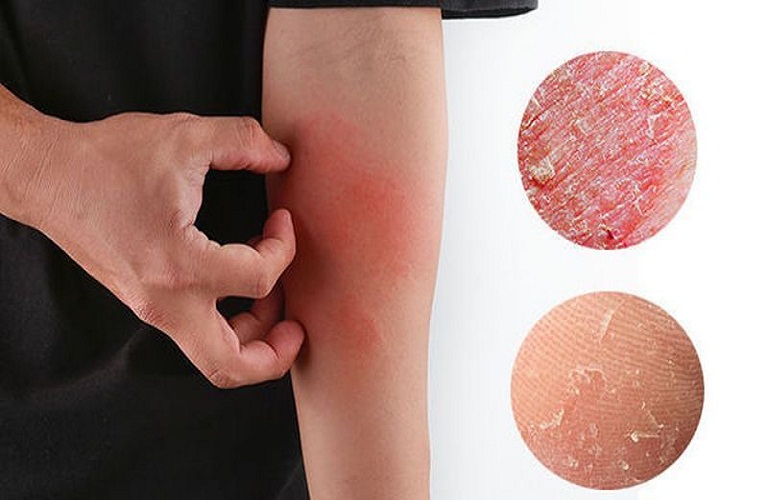 Eczema là một trong số các bệnh về da gây ngứa