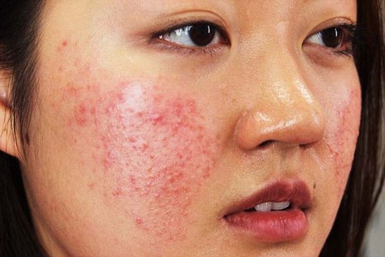triệu chứng dị ứng nổi mẩn đỏ trên mặt