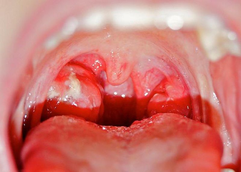 Biểu hiện cổ họng sưng viêm đau rát do viêm họng cấp