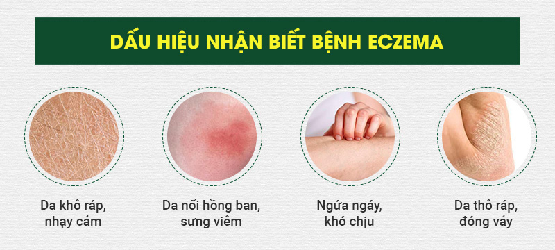 Dấu hiệu nhận biết bệnh eczema 