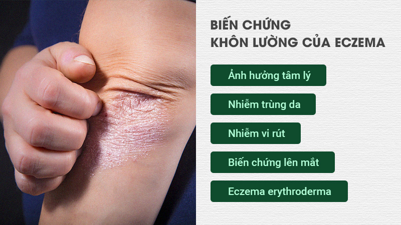 Biến chứng khôn lường của eczema 