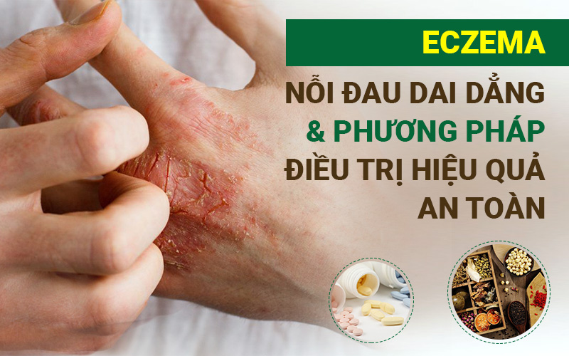 Eczema - Nỗi đau dai dẳng & phương pháp điều trị hiệu quả, an toàn