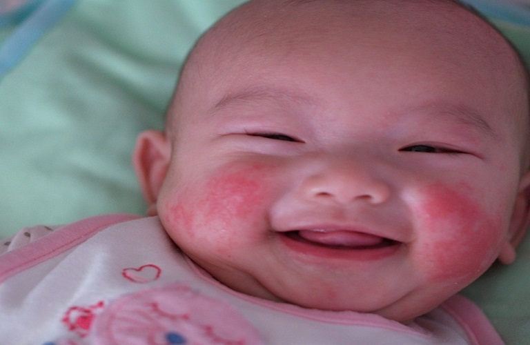 bé sơ sinh bị nổi mẩn đỏ ở mặt 
