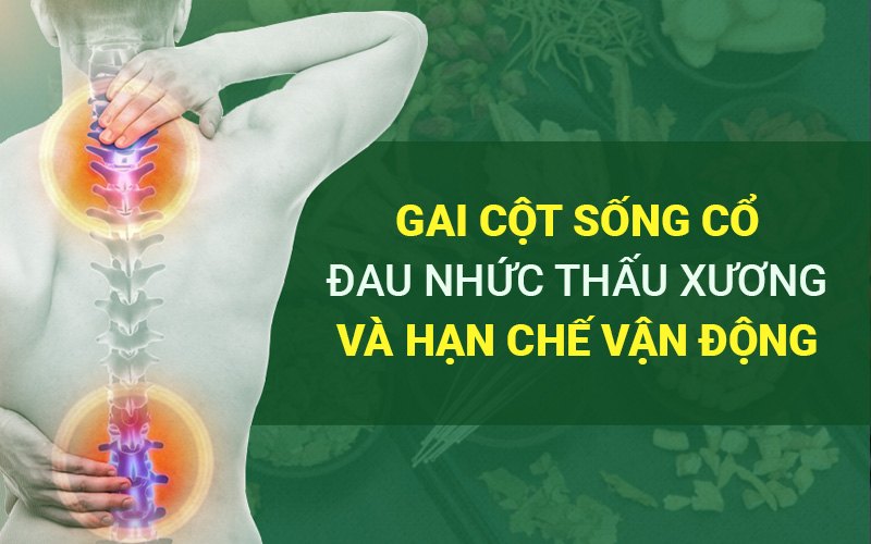 Gai cột sống cổ là gì