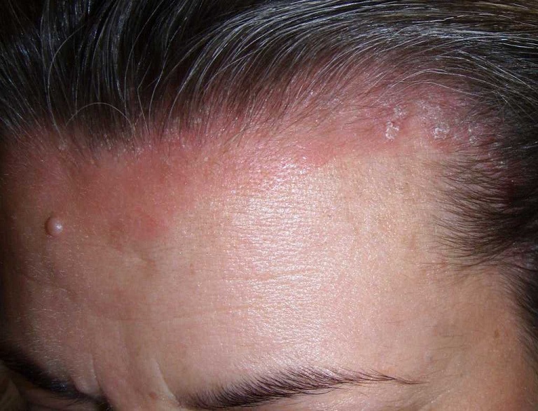 các bệnh về da đầu thường gặp