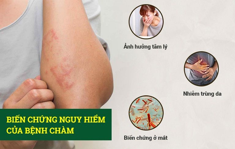 Biến chứng nguy hiểm của bệnh chàm