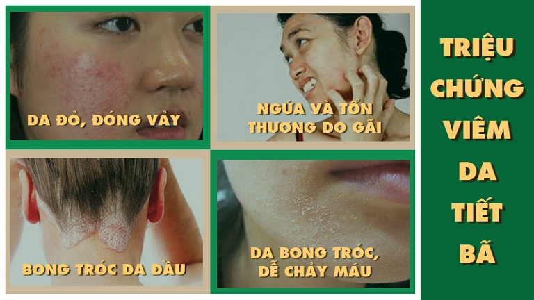 triệu chứng viêm da tiết bã
