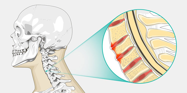 bệnh gai cột sống có chữa được không