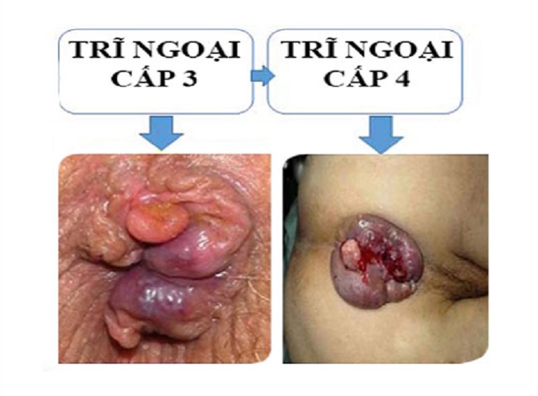 dấu hiệu của bệnh trĩ ngoại