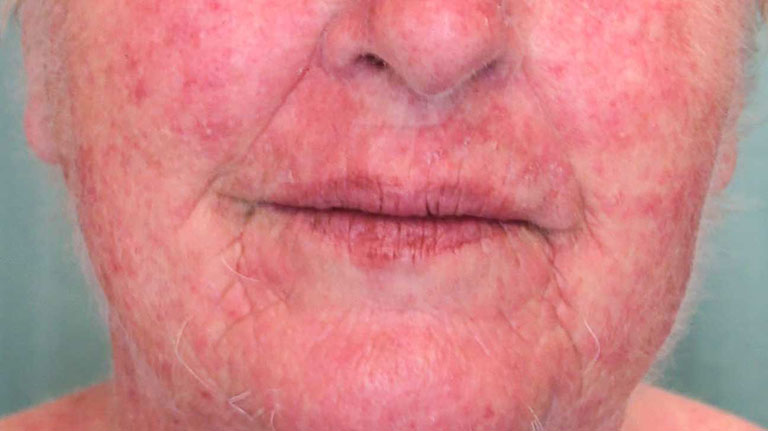 viêm da dị ứng tiếp xúc trên mặt