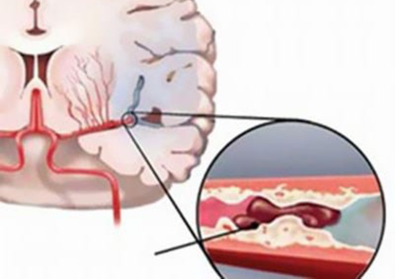 Vì sao bệnh thoái hóa đốt sống cổ gây thiếu máu lên não?