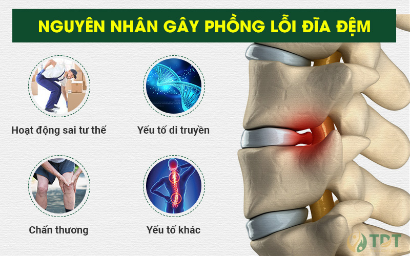 Nguyên nhân gây phồng lồi đĩa đệm