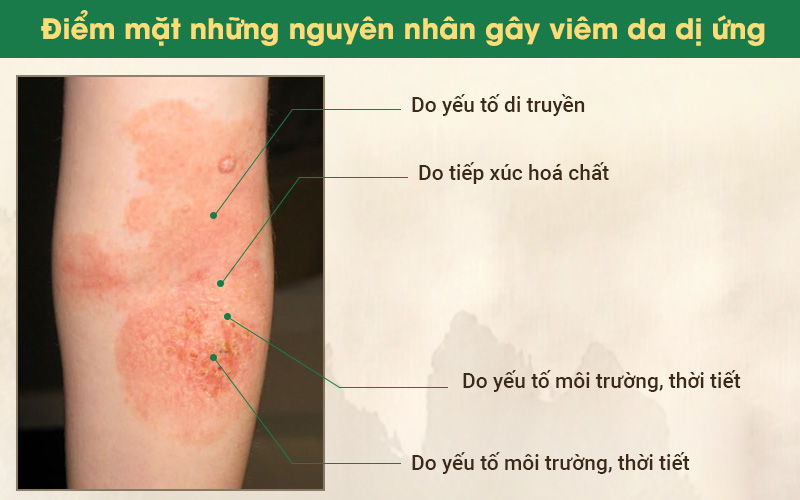 Nguyên nhân viêm da dị ứng