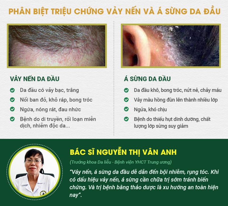 cách phân biệt vảy nến da đầu và á sừng da đầu