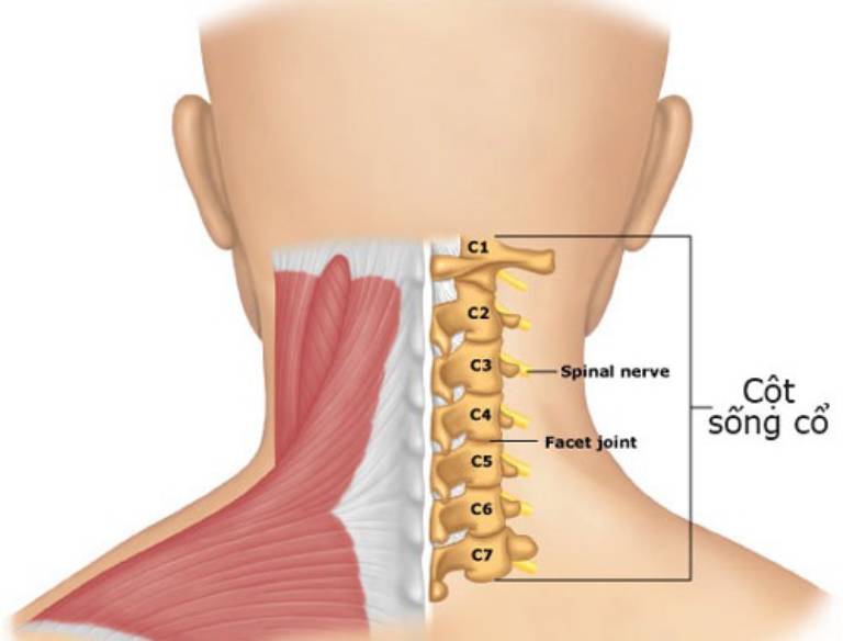 Thoái hóa đốt sống cổ c5 c6 