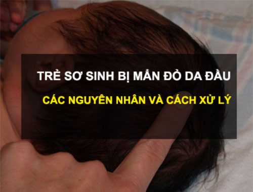 Trẻ sơ sinh bị nổi mẩn đỏ ở da đầu do nhiều nguyên nhân gây ra