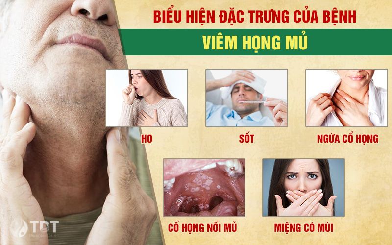 Triệu chứng viêm họng mủ