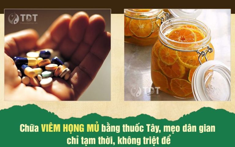 Chữa viêm họng mủ bằng thuốc Tây, mẹo dân gian chỉ tạm thời, không triệt để