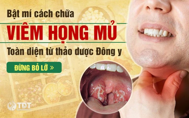 Bật mí cách chữa viêm họng mủ toàn diện từ thảo dược Đông y