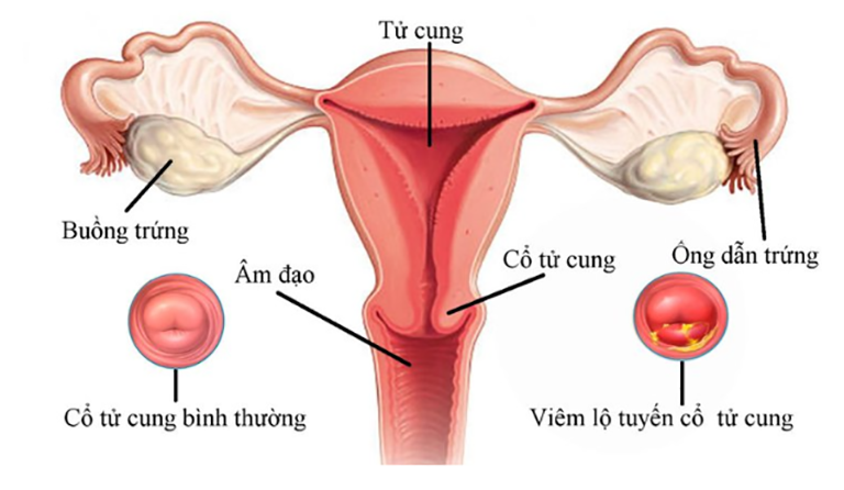 Hình ảnh nhận biết bệnh viêm lộ tuyến cổ tử cung độ 1