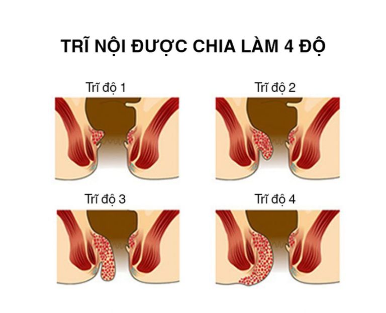 Bệnh trĩ chia thành 4 cấp độ