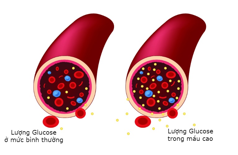 Tiểu đường là tình trạng lượng đường Glucose trong máu luôn tăng cao.