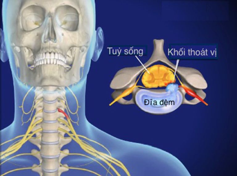 Chèn ép rễ thần kinh