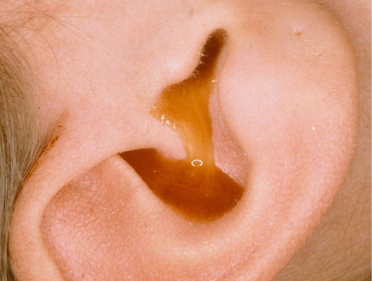 Bé bị viêm tai giữa chảy mủ có nguy hiểm không?