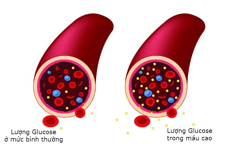 tiểu đường có di truyền không