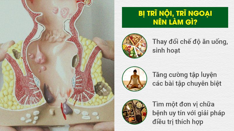 Bị trĩ nội - trĩ ngoại hãy tìm đến các giải pháp trên