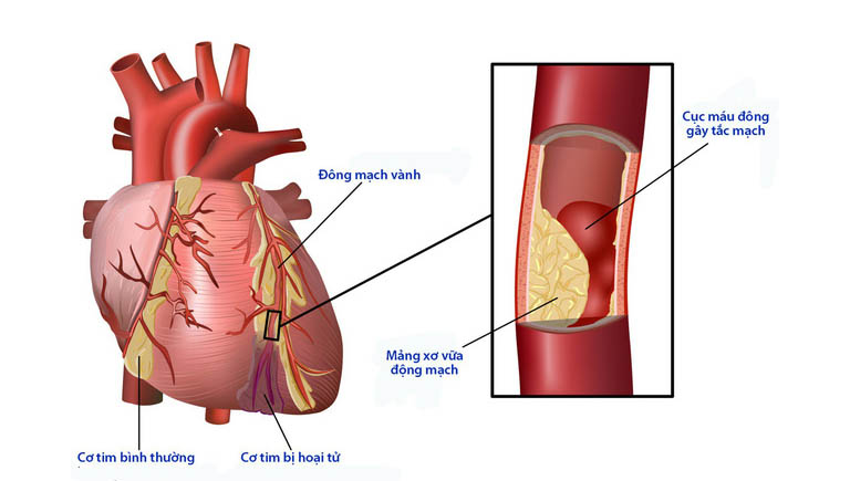 các biến chứng tiểu đường