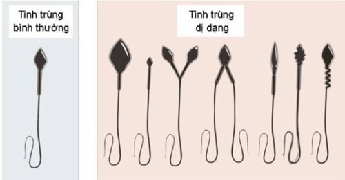 Cách nhận biết tinh trùng khỏe mạnh hay không qua hình dạng