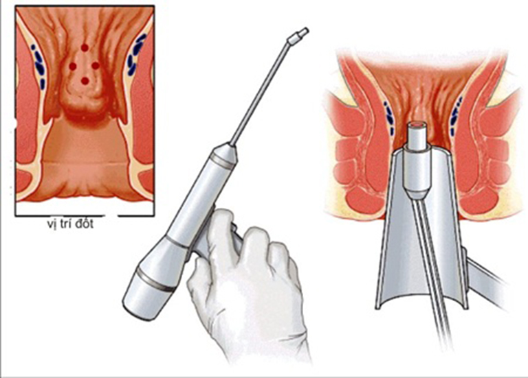 Cắt trĩ bằng phương pháp HCPT